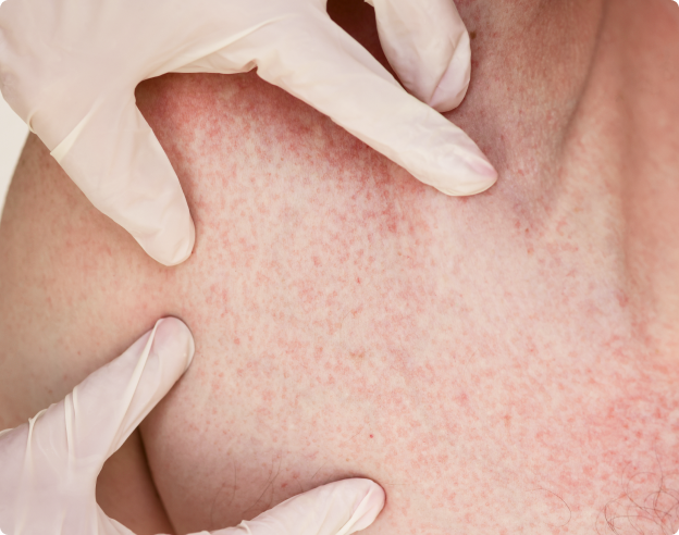 Lupus, ¿qué debo saber?