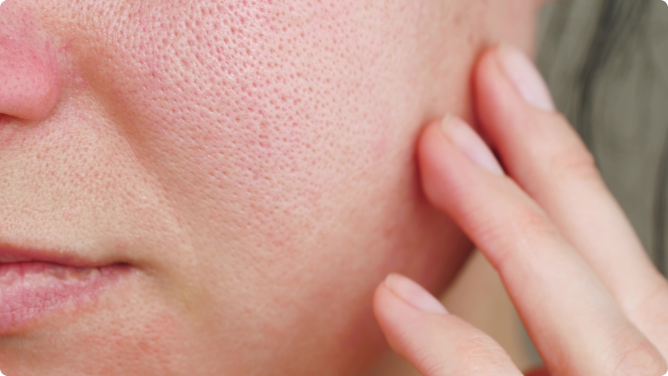 Lupus Eritematoso Sistémico (LES)